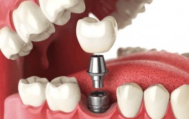Протезирование зубов в клинике "MK Clinic"