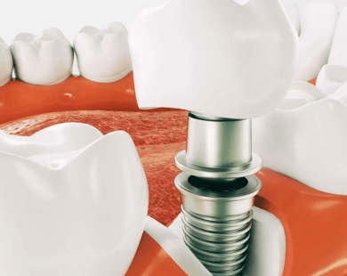 Методика имплантации зубов «все на четырех»
