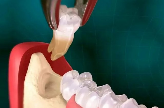 Удаление зуба мудрости: что нужно знать перед процедурой