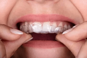 Исправление неправильного прикуса в современной стоматологии